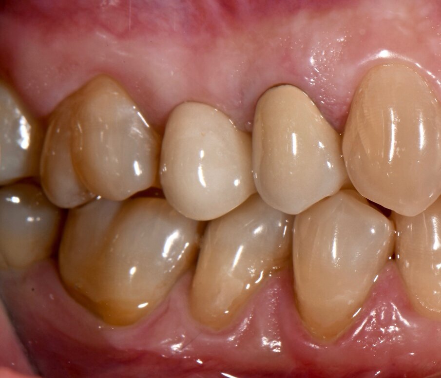 Fig. 5b - Condizione clinica ad 1 anno: I e VI sestante.