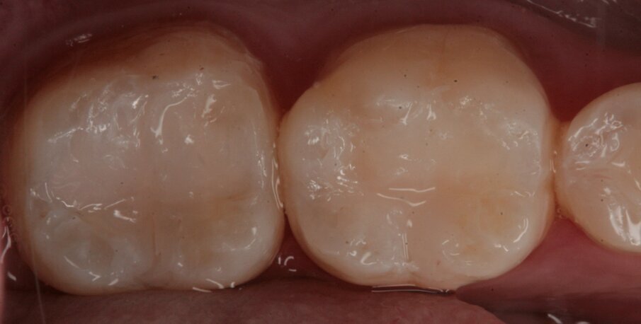Fig. 30_Cementazione manufatto.