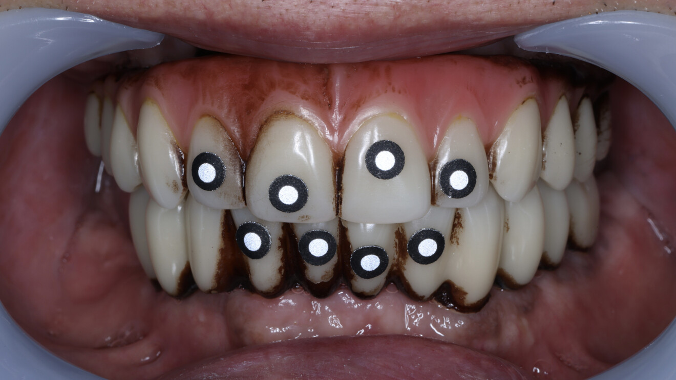 Fig. 16: Jaw motion registration with the maxillary and mandibular provisional prostheses in place.