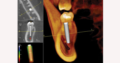 CBCT and implants: a career-altering experience