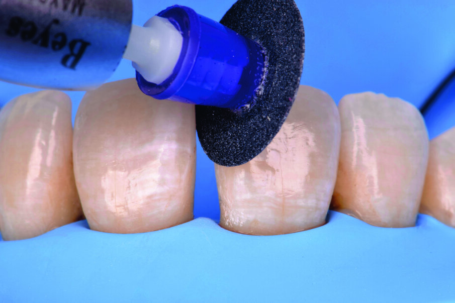 Fig 7. Preparation of enamel surface with Super-Snap Violet disk