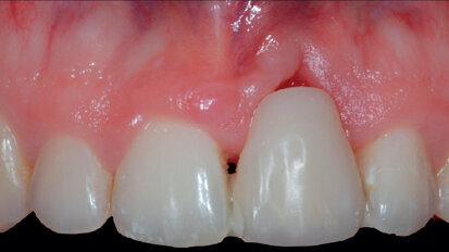 Potenzialità e limiti delle membrane riassorbibili cross linked a lento riassorbimento