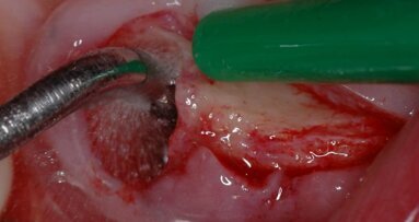 Chirurgia implantare minimamente invasiva nel paziente geriatrico a rischio