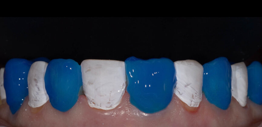 Fig. 6: The restoration is completely additive; the teeth are not prepared at all. Total etching of the enamel is the best pretreatment in this situation. K-ETCHANT Syringe (35% phosphoric acid; Kuraray Noritake Dental) was applied for 10 seconds. 