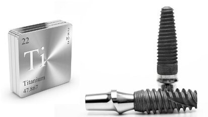 Les implants en titane peuvent comporter un risque de corrosion