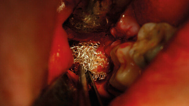 Agenti emostatici locali di sintesi a base di cellulosa ossidata rigenerata
