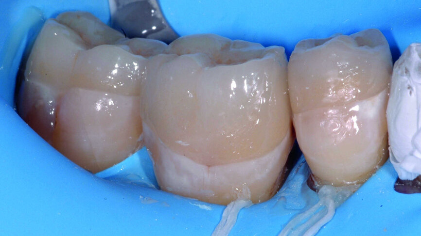 Fig. 16 : Collage et finition effectués