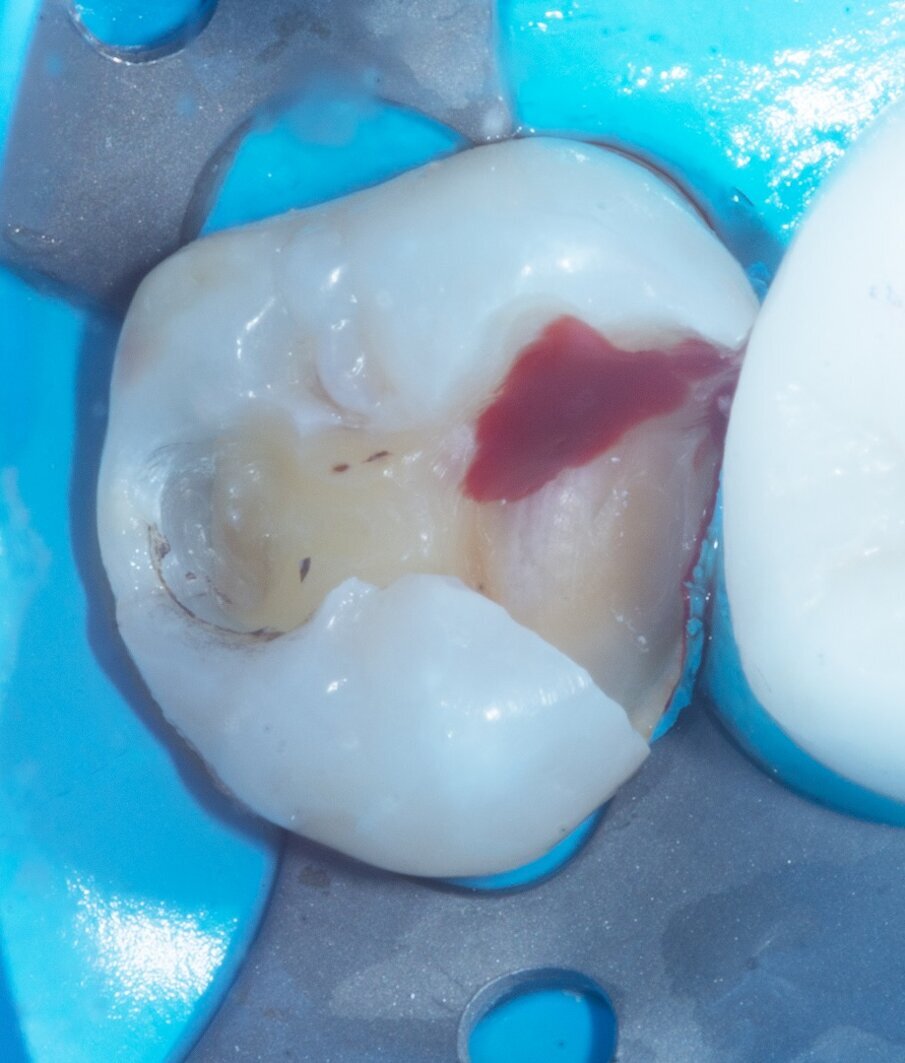 Fig. 2: Pulp exposure after careful curettage.