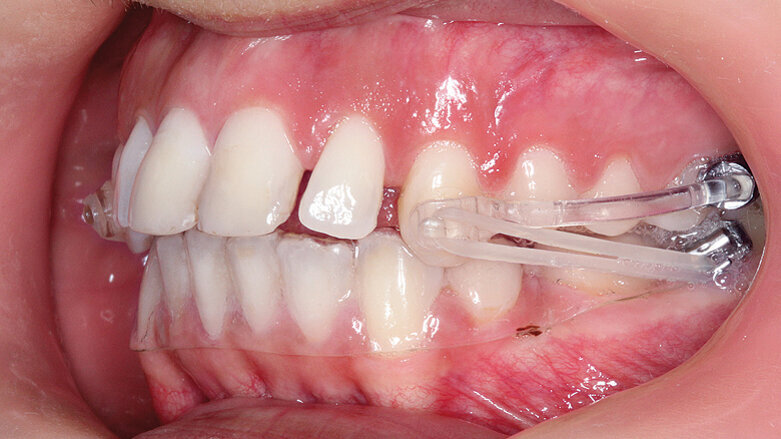 „Sagittal First“