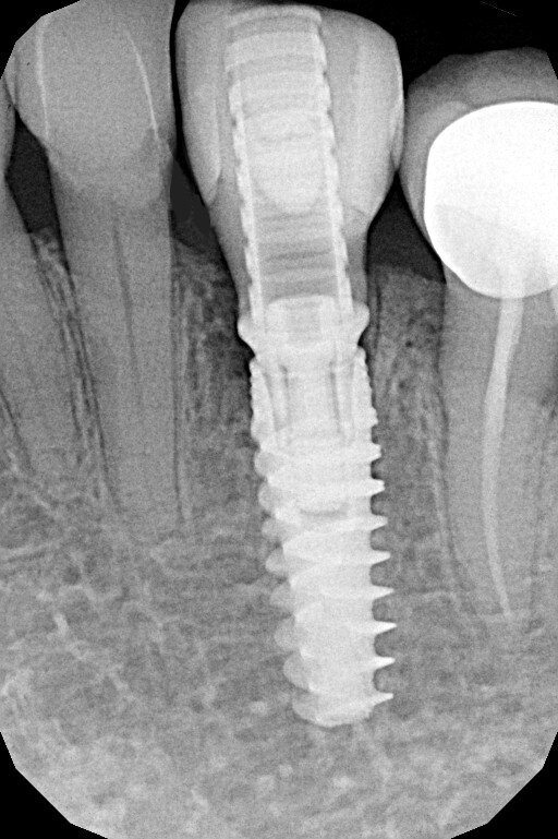 Fig. 13_Rx di fine intervento.