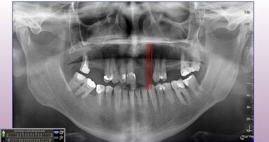 Minimalnie inwazyjne rozwiązania implantoprotetyczne w zaniku poziomym kości szczęki i żuchwy