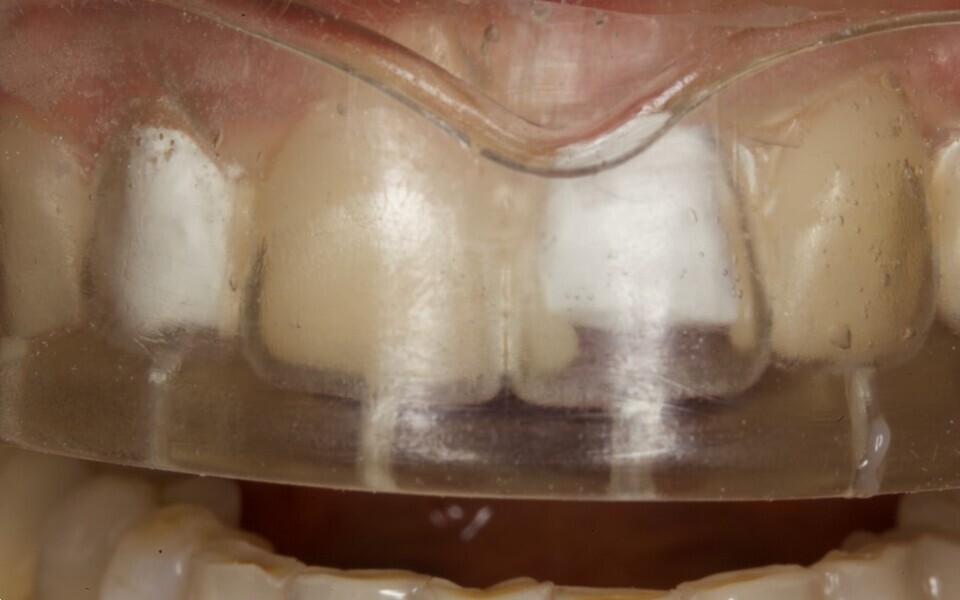 Fig. 12: Index with injected composite.