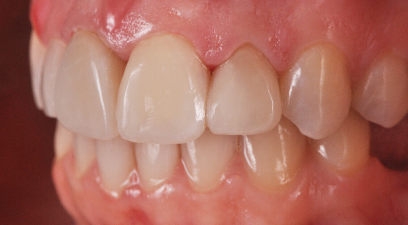 Fig. 22b: Final restoration with lifelike anatomical shape. Lateral view from the left (b).