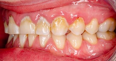 Interview: “Current antimicrobial techniques are largely ineffective ”