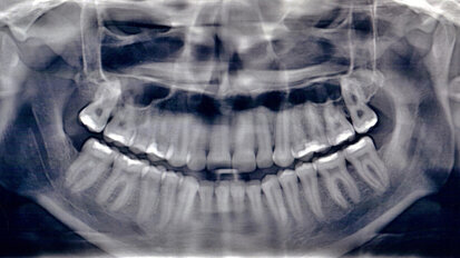 Možnosti akcelerace léčby průhlednými fóliovými aparáty