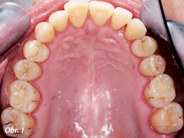 Pohled na okluzi horního oblouku.