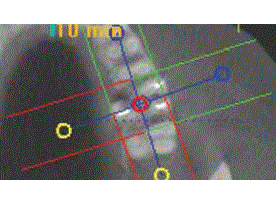 L'utilité du cone beam en endo.