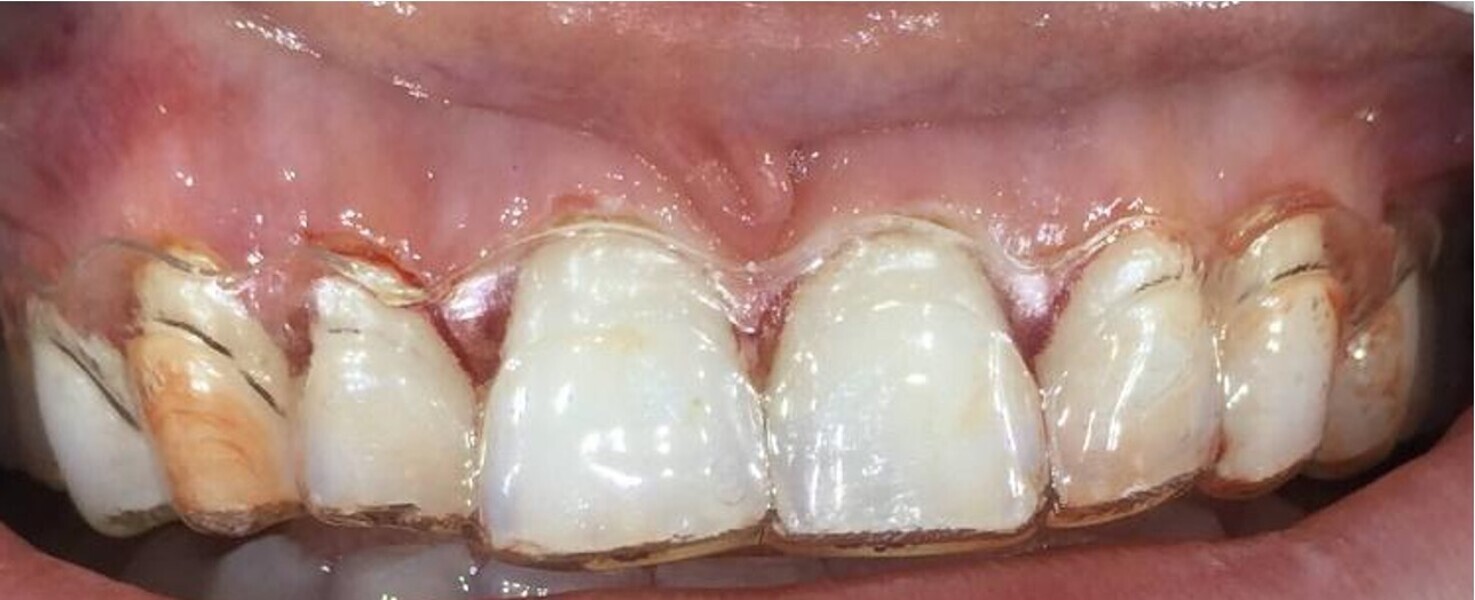 Fig. 8: Close-up view of the surgical guide created using 3D planning, the PRO 4K printer and Zendura thermoplastics.