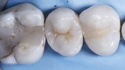 Large MODL Class II restoration with ceram.x® SphereTEC one, Palodent® V3 and SDR® Plus