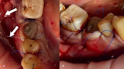 Poncho Lamina Technique: un nuovo approccio in un solo passaggio per l’aumento simultaneo del tessuto duro e molle in singoli siti implantari con atrofia ossea