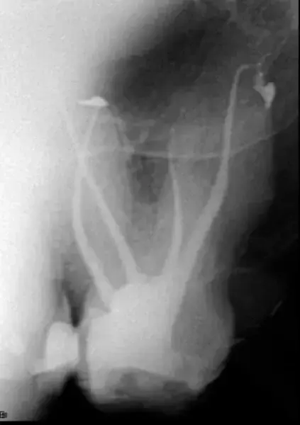 Фиг. 7в Рентгенографии, направени моментално след обтурацията на каналите, показващи 3D запълване на кореновата система под различен ъгъл.