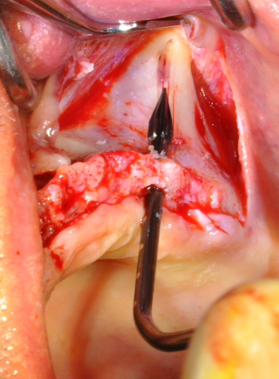 Figg. 11-14 - Preparazione finale.