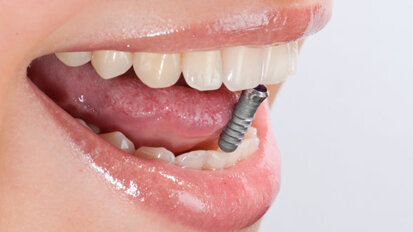 Studienvergleich: Implantate überzeugen