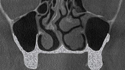 Podniesienie dna zatoki szczękowej z dostępu od strony podniebiennej jako metoda alternatywna