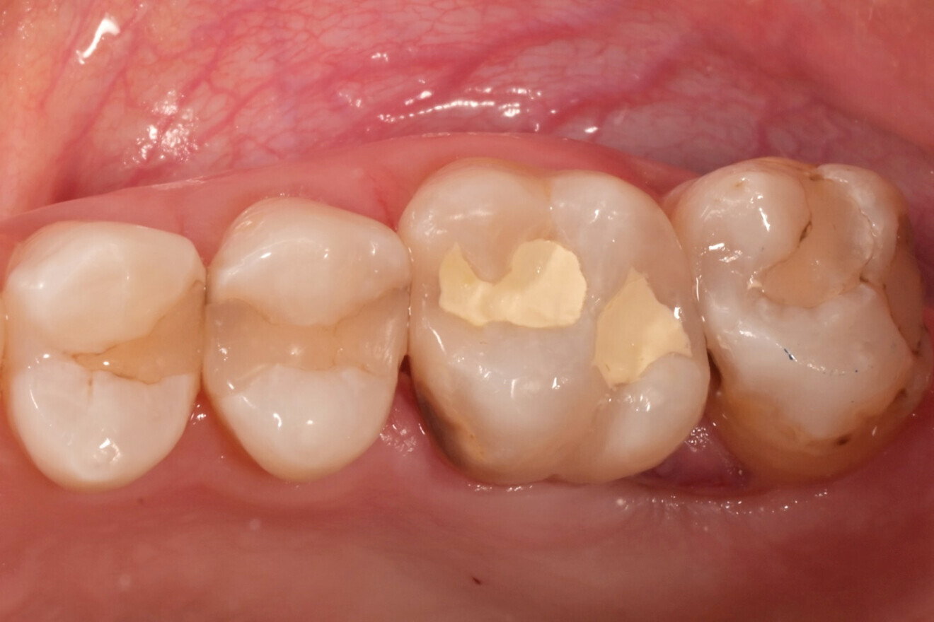 Фиг. 5: Дълготрайна временна обтурация с Biodentine.