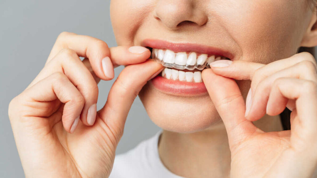 Nhiều cơ quan nha khoa chuyên nghiệp đạt được sự đồng thuận về chỉnh hình răng tự làm