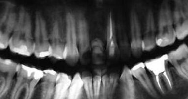 Przypadki rekonstrukcji implantoprotetycznej – obserwacje kilkuletnie