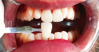 Post-hygiene whitening for everyone