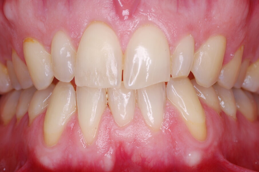 Figg. 45-50_Fotografie intraorali frontali in sequenza che illustrano il progressivo livellamento e allineamento e il raddrizzamento dell’incisivo laterale mandibolare destro.