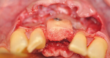 Přežití alogenních kortikospongiózních kostních bloků