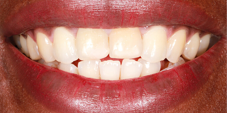 Fig. 16: The UR1 and UL1 of this 23-year-old female were damaged in an accident and restored with composite material.