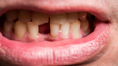 Smoking cessation may decrease risk of tooth loss Smoking cessation may decrease risk of tooth loss