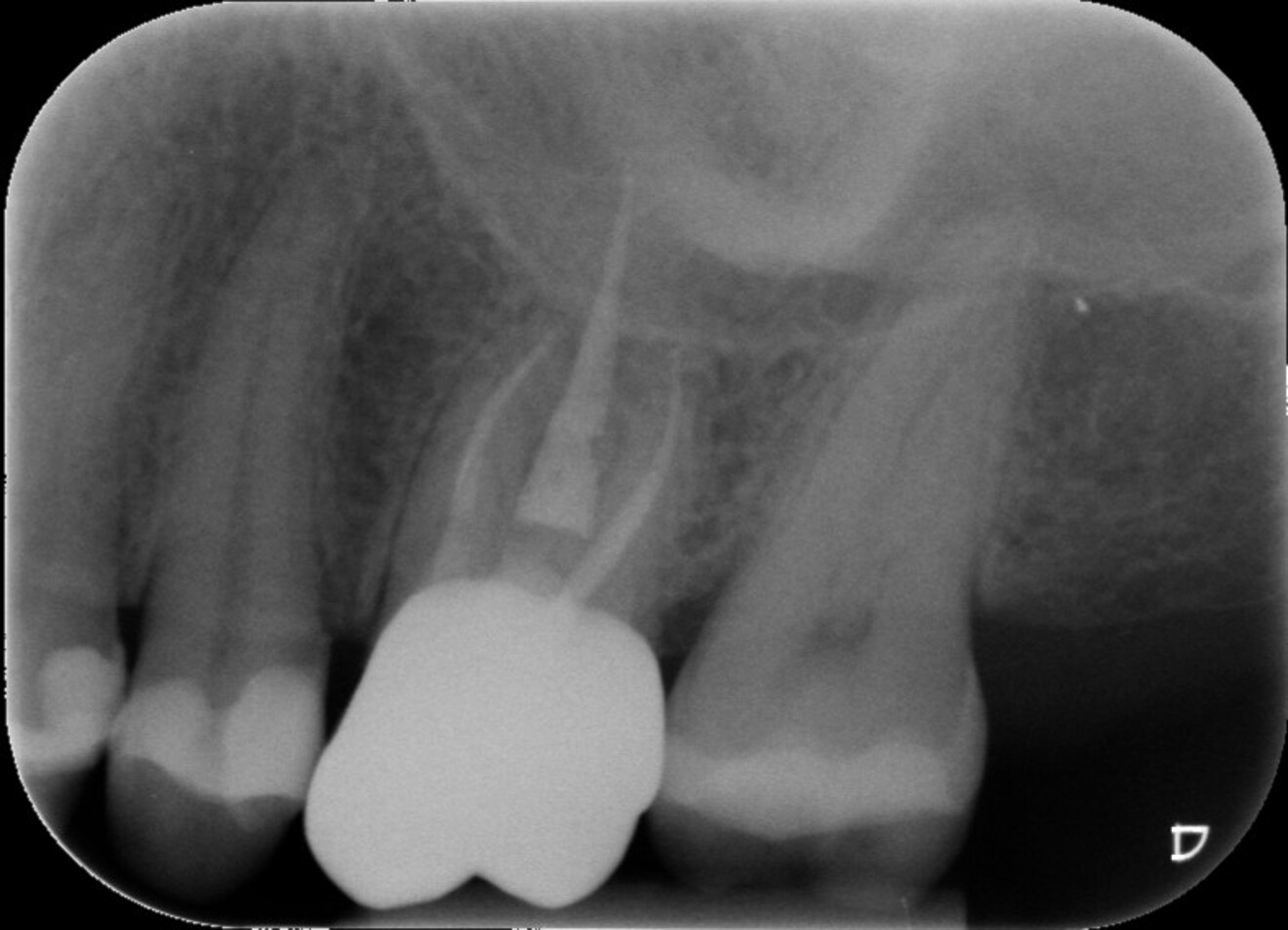 Fig. 12 : Radiographie de suivi après trois ans.