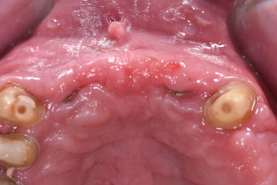 Fig. 24_Dopo 4 mesi abbiamo rimosso il provvisorio per capire come si era conformato il tessuto gengivale al di sotto dello stesso. Dopo altri due mesi abbiamo provveduto a opercolarizzare usando un diatermocoagulatore.