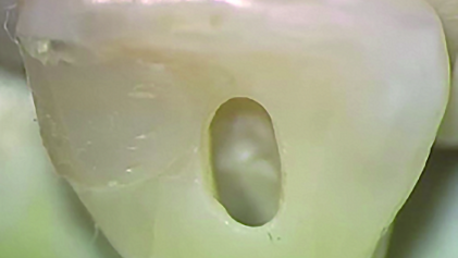 Cutting endodontic access cavities— for long-term outcomes