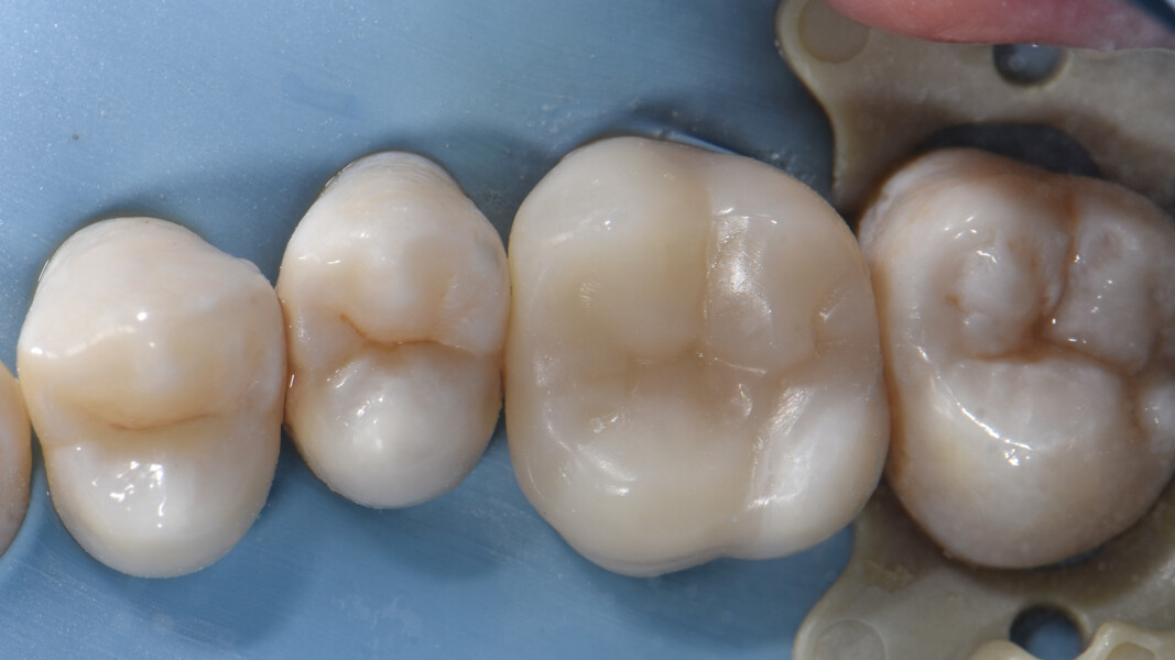 Fig. 29a: Restoration immediately after polishing of the margins, occlusal view.