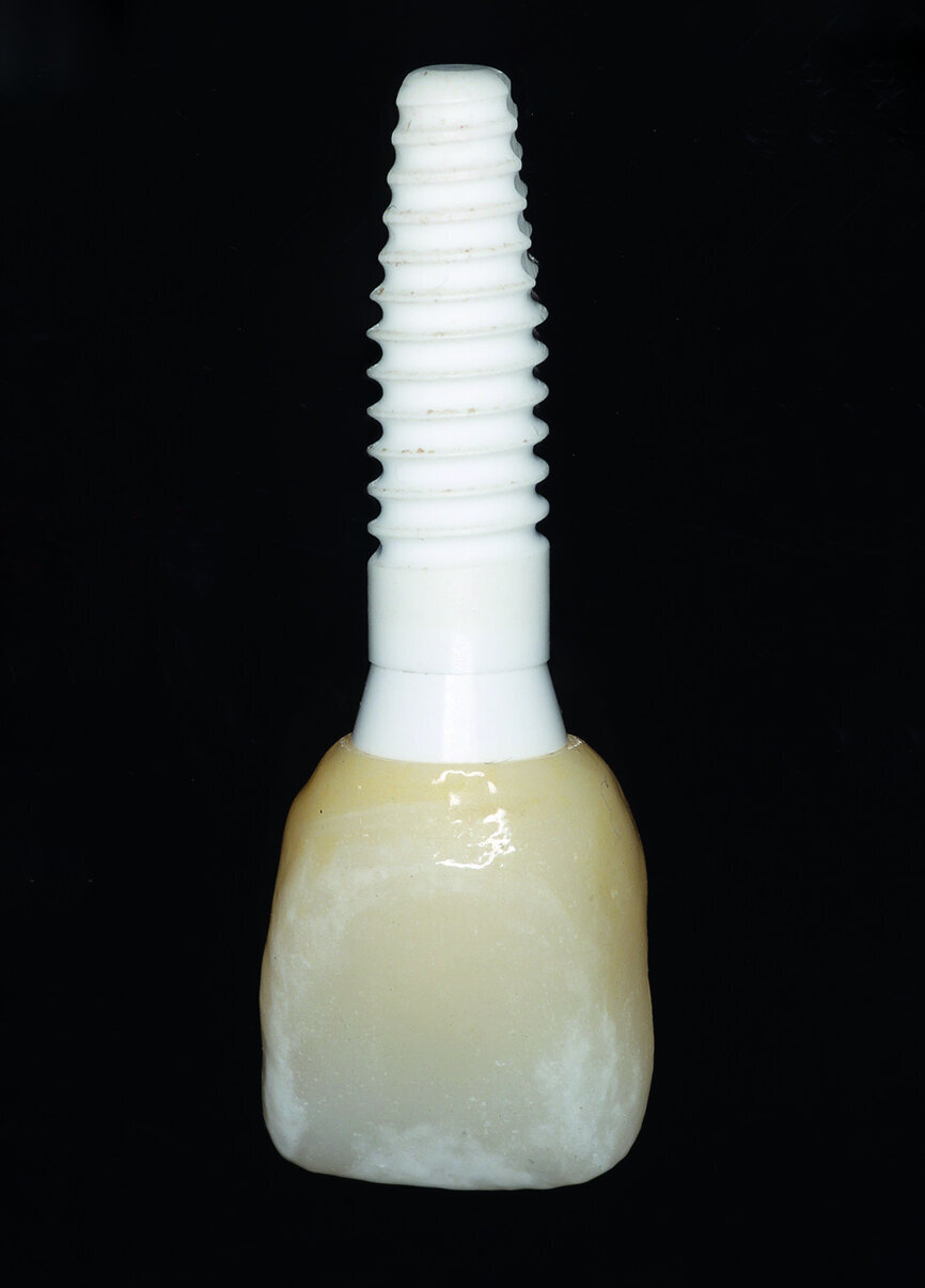 Fig. 10a: The definitive zirconia crown was fixed to the customised abutment made of alumina-toughened zirconia.
