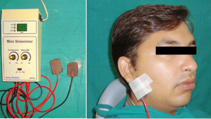 La terapia eléctrica puede aliviar la xerostomía