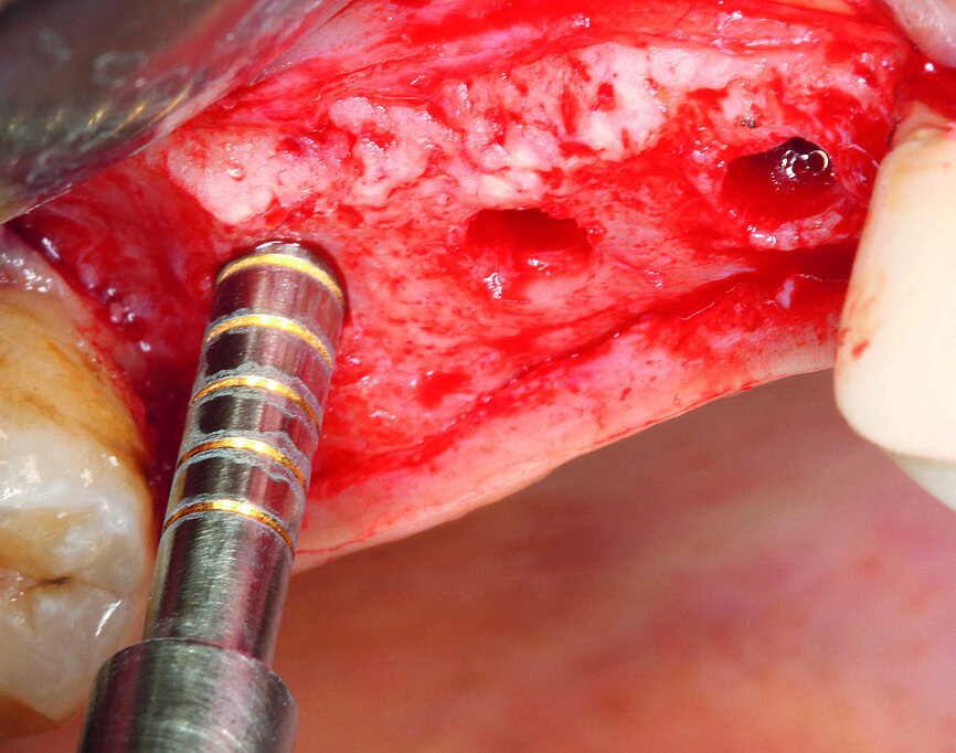 Fig. 9 : Élévation du plancher sinusien très peu invasive au moyen d’un ostéotome dans la région dentaire 17.
