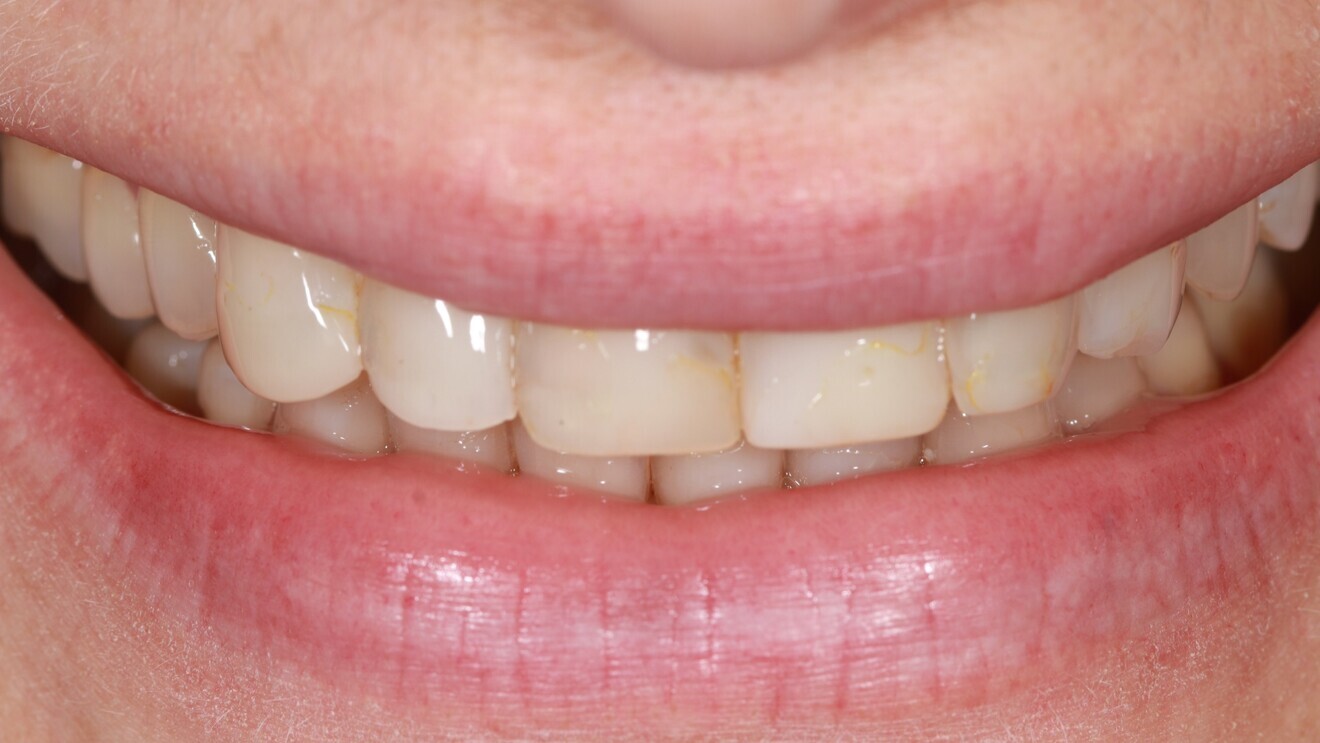 Figs. 3a & b: Smile makeover with porcelain veneers: before (a) ...