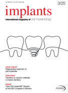 implants international No.3, 2025 implants international No.3, 2025