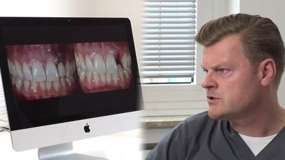 Immediate restoration in the esthetic zone using bone level tapered implants