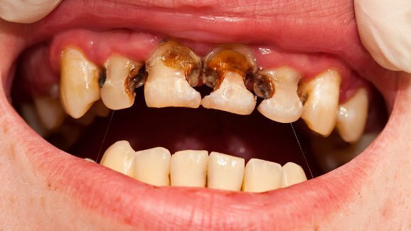 Хора с нарушения в окосмяването могат да бъдат по-податливи към кариеси