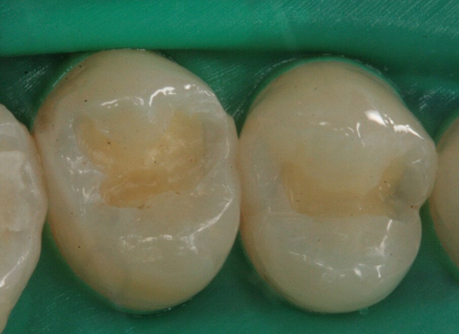 Fig. 10_Isolamento del campo operatorio e preparazione della cavità.