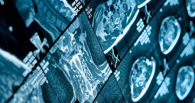 AO Orlando preview: Sinus floor bone graft