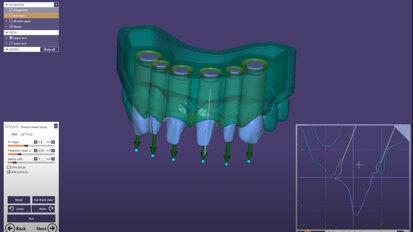 exocad – Video Tutorial: Model Creator
